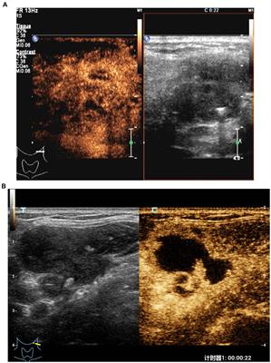 The value of multimodal ultrasonography in evaluating therapeutic response of cervical tuberculous lymphadenitis to anti-tuberculosis drugs